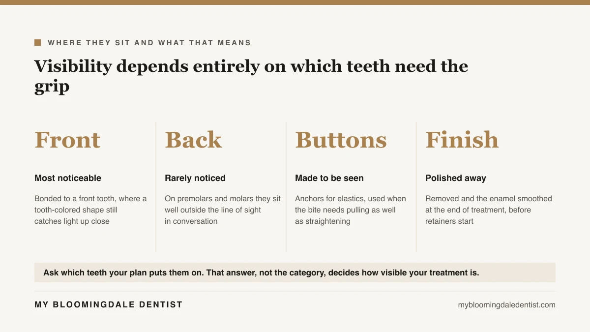 Four column diagram showing attachments on front teeth, back teeth, elastic buttons, and the polishing step at the end